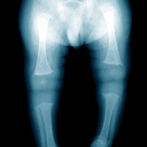 Rickets Xray - Bowing of legs